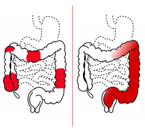 Crohnova choroba - Ulcerozna kolitida